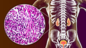 Chronic kidney disease, illustration and light micrograph