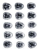 Walnuts in a group, X-ray