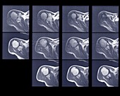 Multiple scans of shoulder joint, MRI