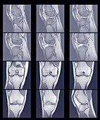 Multiple scans of knee joint, MRI