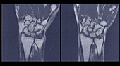 Scans of wrists, MRI