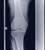 Knee joint, X-ray