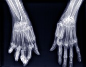 Hands, X-ray