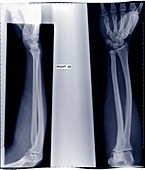Films of two arms and wrists, X-ray