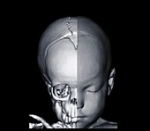 Image of baby's head and half skull, CT scan