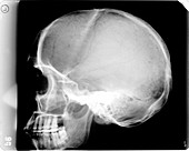Human skull with light bulb, X-ray