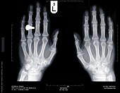 Hands and ring, X-ray