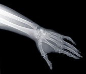 Arm and hand, X-ray