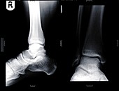 Ankles, X-ray