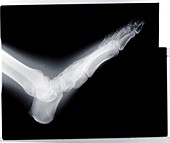 Human foot, X-ray