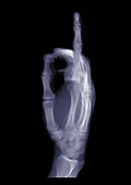 Hand holding up an index finger, X-ray