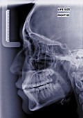 Skull and face, X-ray