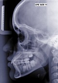 Skull and face, X-ray