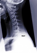 Human vertebrae, X-ray
