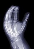 Hand, X-ray