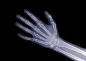 Open hand, X-ray