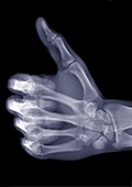 Hand with thumb up, X-ray