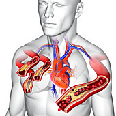 Angioplasty with stent placement, illustration