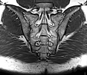 Sacrum, MRI scan