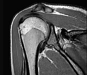 Healthy shoulder joint, MRI scan