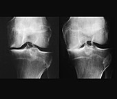 Knee osteoarthritis, X-rays