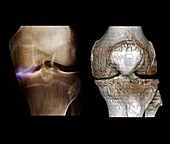 Knee osteoarthritis, X-ray and CT scan