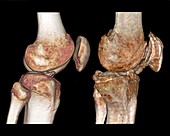 Healthy and arthritic knees, CT scans