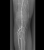 Blocked leg artery, angiogram