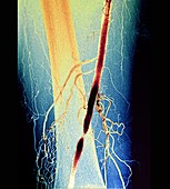 Narrowed leg artery, angiogram