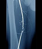 Narrowed leg artery, angiogram