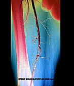 Leg artery angioplasty, angiogram