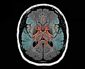 Brain arteries, 3D MRI scan