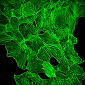 Cancer cells green, light micrograph