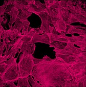 Cancer cells showing actin filaments, light micrograph