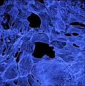 Neuroblastoma cells showing cytoskeleton, light micrograph