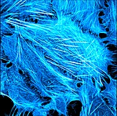 Osteosarcoma showing actin cytoskeleton, light micrograph