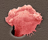 Sarcoma cancer cell, SEM