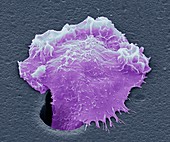 Sarcoma cancer cell, SEM