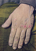 Erythema multiforme, historical image