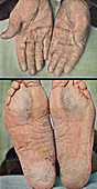 Palmoplantar keratoderma, historical image