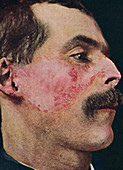 Lupus erythematosus, historical image