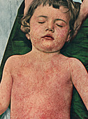Child with measles, historical image