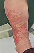 Varicose eczema, historical image