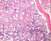 Metastatic breast cancer in bone, light micrograph
