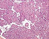 Thyroid papillary carcinoma, light micrograph