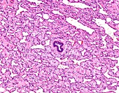 Angiosarcoma of breast, light micrograph