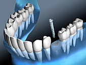 Inserting dental implant, illustration