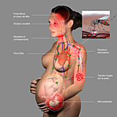 Pregnancy and zika virus, illustration