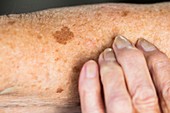 Liver spots on elderly skin