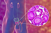 Benign prostatic hyperplasia, illustration and micrograph